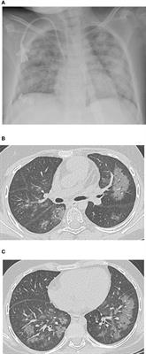 Pulmonary Complications in Children Following Hematopoietic Cell Transplantation: A Case Report and Review of the Diagnostic Approach